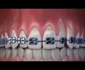 Pinhole Gum Treatment
