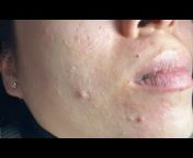 Acne treatment Hương Đà Nẵng