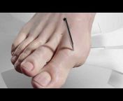 Minimally-Invasive Foot u0026 Ankle Surgery