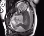 An MRI scan shows an unborn baby at 29 weeks. He is still trying to stretch his legs out, but he&#39;s growing fast and there&#39;s less space in the womb now.nnsee webapp:nhttps://web.bestbeginnings.org.uk/web/video/mri-scan-at-29-weeks-11351/videos