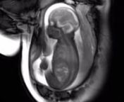 An MRI scan shows an unborn baby at 30 weeks. You can see her chest moving in and out as she practices her breathing.nnsee webapp:nhttps://web.bestbeginnings.org.uk/web/video/mri-scan-at-30-weeks-11361/videos