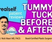 ➡️Review some of our Tummy Tuck before and after images, along with patient testimonials in this video to help you select the best tummy tuck surgeon in Miami.nnAlso known as abdominoplasty, a tummy tuck surgery involves the removal of loose skin, the tightening of abdominal muscles, and the elimination of stubborn fat deposits to achieve a better-looking figure. Find more pictures of tummy tuck before and after: https://facebody.net/tummytucknn➡️➡️➡️Looking for best tummy tuck s
