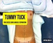Tummy Tuck for Excess Skin &amp; Muscle Separation www.drtim.com.au. DrTim demonstrates a tummy tuck (aka abdominoplasty) for loose, excess skin on a background of significant muscle separation (rectus diastasis). The procedure involves 4 stages:n1. Liposuctionn2. Mobilisation tissuesn3. Removal excess skin &amp; fatn4. Reconstruction of the umbilicus &amp; closure of woundnThe before &amp; after photos at 3 months show a trim, taught and well contoured abdomen, as well as, a rejuvenated mons pu