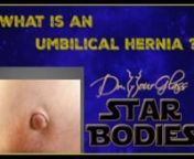 Hi, this is Dr. Hourglass, and welcome to another video in our channel Star Bodies. Today we are going to discuss what an umbilical hernia is. In this channel, we discuss everything you need to know to get that star body that you want.nnWelcome back. It is not uncommon while performing a tummy tuck or any aesthetic surgery of the abdomen for the surgeon to encounter an abdominal hernia. The most common hernia that has surgical implications during a tummy tuck is the umbilical hernia, which is a