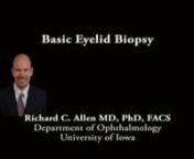 This is Richard Allen at the University of Iowa.This video demonstrates a basic eyelid biopsy.The patient has a cystic appearing lesion of the lateral upper lid.Using Westcott scissors and toothed forceps, the lesion is excised.A 15 blade could be used if preferred.There is some disadvantage to using scissors since they may induce crush artifact.I believe that all [eyelid] lesions should be inspected by the pathologist.Hemostasis can be attained with bipolar or thermal cautery.An