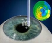 A short overview of the PRK procedure. Photorefractive keratectomy (PRK) is a type of refractive surgery.With PRK, your ophthalmologist uses a laser to change the shape of your cornea. This improves the way light rays are focused on the retina. PRK is used to treat myopia (nearsightedness), hyperopia (farsightedness) and astigmatism.