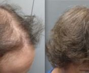 Paciente de 41 años con diagnóstico de FAGA y tricotilomanía, sin tratamiento médico al momento de la consulta. No refiere agudizaciones en los últimos 2 años. Se instaura tratamiento con finasteride y Nacetil cisteína para estabilizar su alopecia y controlar futuras recaídas. Después de 11 meses se realiza intervención quirúrgica con la extracción de 3051 grafts y rasurado completo (5667 pelos; 1,86 pelos/graft; 45-48 micras de pelo;0.8 mm punch; 772G1/ 1388G2/ 656G3/ 34G4/ 1G5).