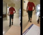 The 33-year old gentleman who was diagnosed with dropped foot after traumatic brain injury has walking and balance problems.nNow he is using the XFT G3 Foot Drop System. Visit www.xft-china.com for more info.