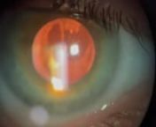 This video is part of an EyeRounds Atlas entry showing a hanging elschnig pearl. nhttps://eyerounds.org/atlas/pages/Aftercataract-Elschnigs-pearls.htmlnnnPhotographer: Kaleigh HausnContributors: C.Y. Lewis, MD, MPH; Kaleigh Haus