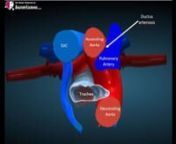 Anatomy of the foetal heart 3 vessel view showing the Pulmonary artery, Aorta and Superior vena cava.nRef anatomyLearning.com