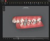 ORTHOSMILE 3D SCAN simulation Invisalign.mp4 from 3d mp4