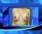 In this video Dr.Cortes explains how the nipples are an important component of aesthetic breadt surgery.nnFor more information visit www.rejuvenusaesthetics.com