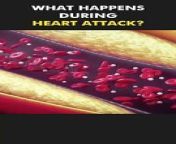 What Happens During Heart Attack? (3D Animation)&#60;br/&#62;#heartattack #cardiacarrest #heartblockage #coronaryarterydisease #heartblockage3d #medical3danimation #3dmedicalanimation #cad #arteryblockage #atherosclerosis #fatinarteries #medical3danimation #3dmedicalanimation #heartdisease #heartattacksurvivor