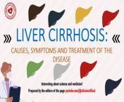 Liver cirrhosis is a fairly serious disease, as a result of which some hepatocytes are destroyed, forming scar tissue.&#60;br/&#62;The most dangerous complication of this disease is liver failure.&#60;br/&#62;Poor blood circulation in the liver can cause varicose veins of the esophagus.&#60;br/&#62;There are about 100 million patients with liver cirrhosis on our planet, and 500 thousand deaths are recorded annually.&#60;br/&#62;The main signs of liver cirrhosis are: spider-like blood vessels on the chest and shoulders; menstrual cycle disorders in women; loss of sexual desire; breast enlargement in men; fatigue; sleep problems; redness of the palms; swelling of the legs and arms; prolonged itching; abdominal enlargement; blood vomiting; black stool with blood; dark colored urine; jaundice of the skin and eyes; significant weight loss/gain.&#60;br/&#62;The liver of a healthy adult weighs 2.5 kg.&#60;br/&#62;The most important functions of the liver are: producing bile, maintaining normal blood composition, detoxifying the body, destroying damaged red blood cells, maintaining immunity.&#60;br/&#62;The liver can work even if 70% of its weight is destroyed.&#60;br/&#62;The causes of liver cirrhosis can be: alcohol abuse; long courses of drug treatment; prolonged exposure to harmful substances on the body; long-term bile obstruction; genetic defects; viruses.&#60;br/&#62;Alcohol abuse can cause severe damage to the liver, outweighing the beneficial effects on the cardiovascular system.&#60;br/&#62;Women can consume 1-2 glasses of wine per day, and men about 2-3 glasses. But these values ​​may be lower depending on your health status.&#60;br/&#62;Alcoholic hepatitis and fatty degeneration of hepatocytes (fatty hepatosis) can affect the development of liver cirrhosis.&#60;br/&#62;Hepatitis B and C viruses can cause cirrhosis of the liver.&#60;br/&#62;In Wilson-Konovalov disease, copper accumulates in the liver, and in hemochromatosis, iron accumulates. Both diseases can be complicated by cirrhosis.&#60;br/&#62;Galactosemia is characterized by impaired carbohydrate metabolism, which negatively affects the liver.&#60;br/&#62;Congenital bile duct defects and gallstones are also possible causes of this disease.&#60;br/&#62;Diagnosis of liver cirrhosis includes liver tests and liver tissue biopsy.&#60;br/&#62;Treatment of the disease requires changes in diet, avoidance of contact with various chemicals, treatment of hepatitis or Wilson-Konovalov disease, hemochromatosis, and complete abstinence from alcohol.&#60;br/&#62;Liver transplantation is the last resort for treating the disease. But it may not be suitable for everyone due to various risks.&#60;br/&#62;Milk thistle is used to treat cirrhosis.&#60;br/&#62;Nutrition for cirrhosis includes various recommendations. It is especially important not to abuse alcoholic beverages and medications, and to avoid consuming raw shellfish and crustaceans.