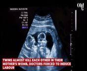 Twins almost kill each other in their mother's womb, doctors forced to induce labour from agri labour qld